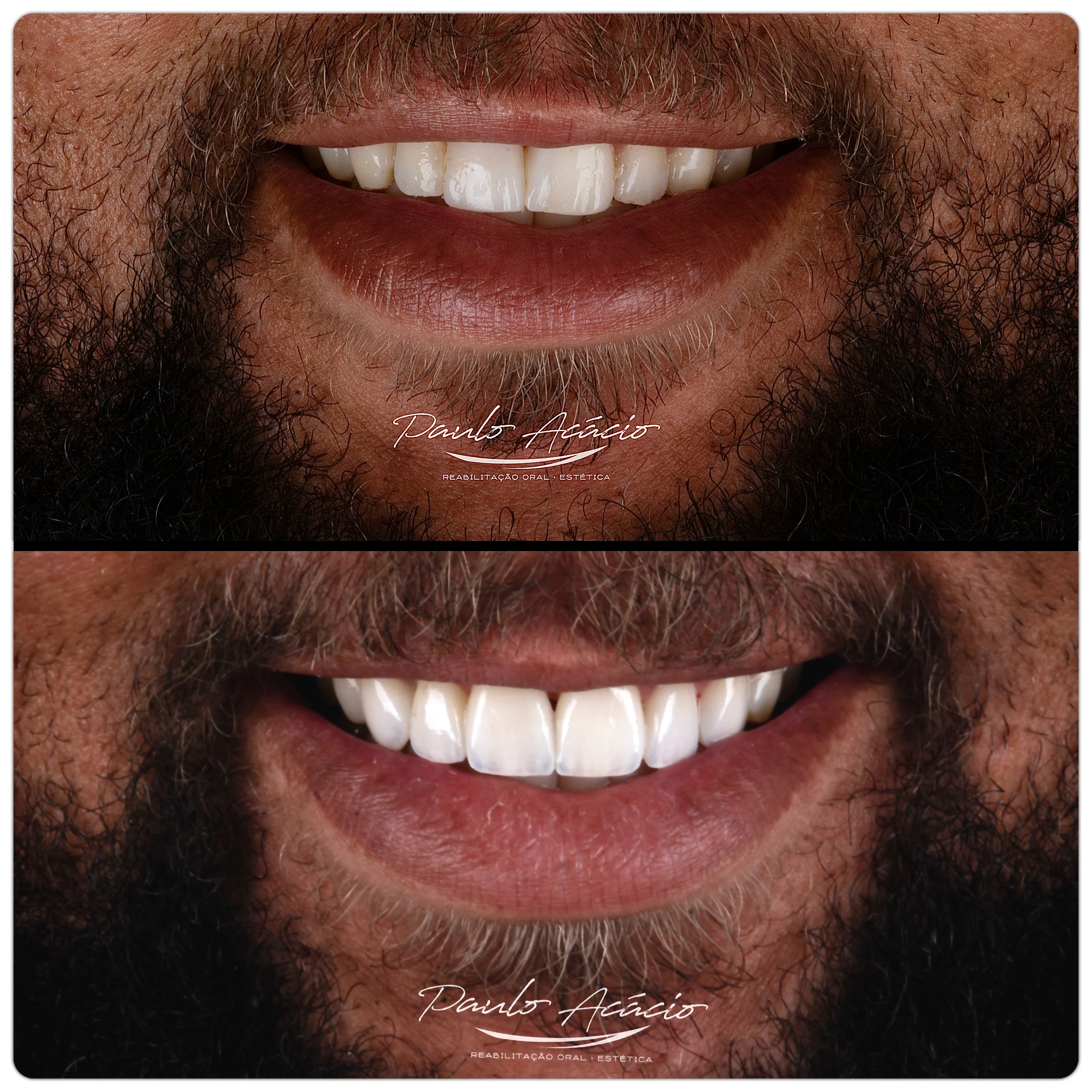 Antes e depois de facetas de porcelana