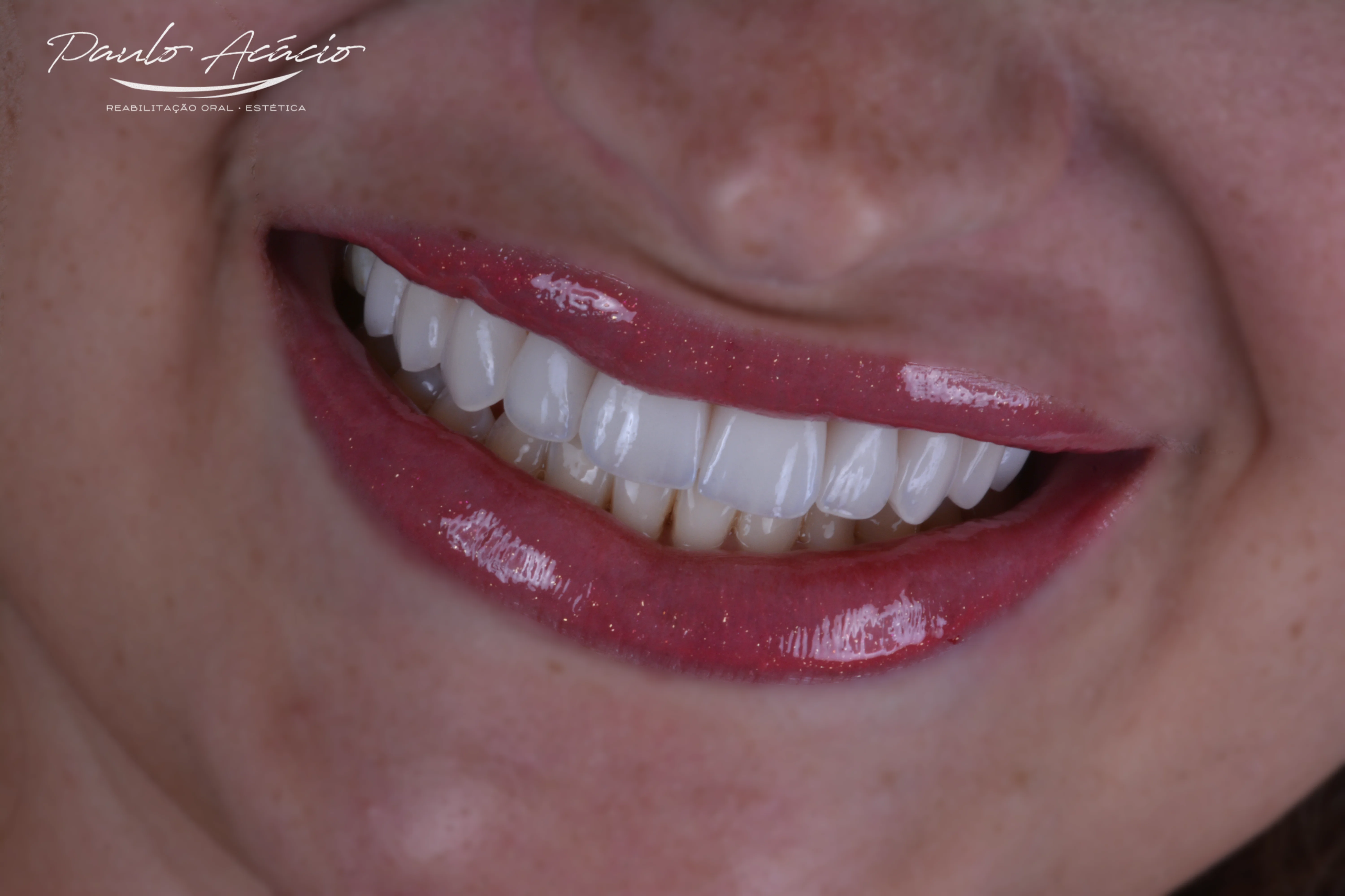 Resultado final de facetas